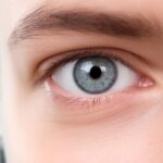 Détecter les symptômes du kératocône : comprendre, diagnostiquer, et traiter avec les solutions adaptées